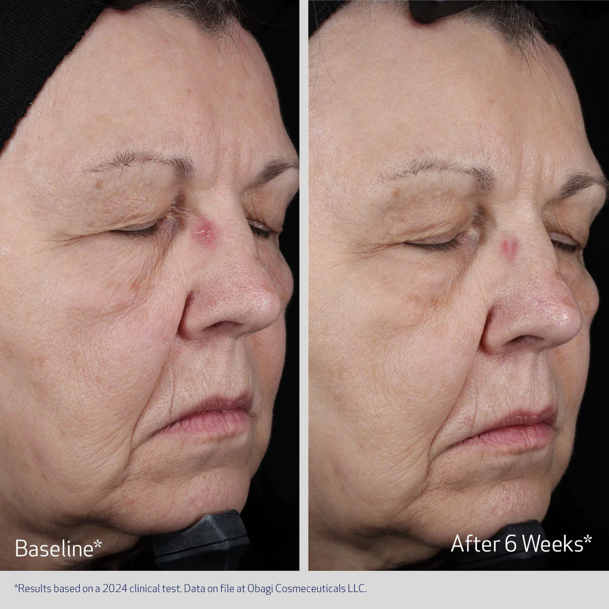 Obagi ELASTIderm Lift up & Sculpt Facial Moisturizer resultaat na 6 weken