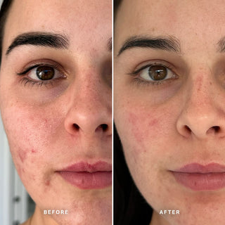 Alpha-H Clear Skin Tonic resultado antes y después tres
