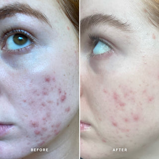 Alpha-H Clear Skin Tonic resultado antes y después dos