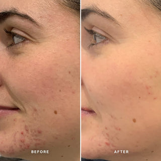 Alpha-H Clear Skin Tonic resultado antes y después cuatro
