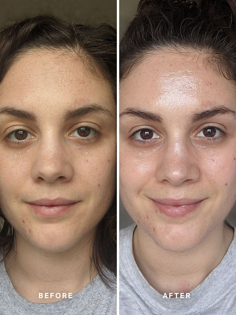 Alpha-H Liquid Gold Exfoliating Treatment antes y después resultado dos