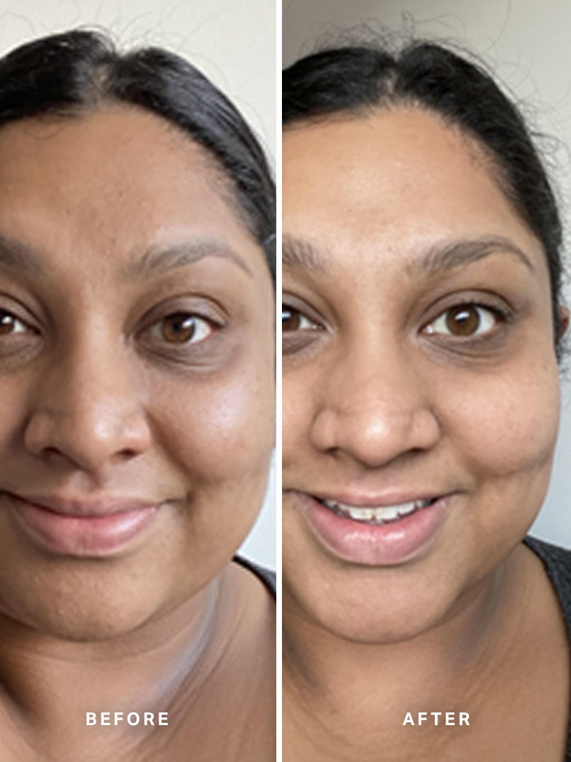 Alpha-H Liquid Gold Exfoliating Treatment antes y después resultado cuatro