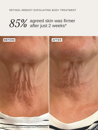Alpha-H Retinol Reboot Exfoliating Body Treatment antes y después piel más firme