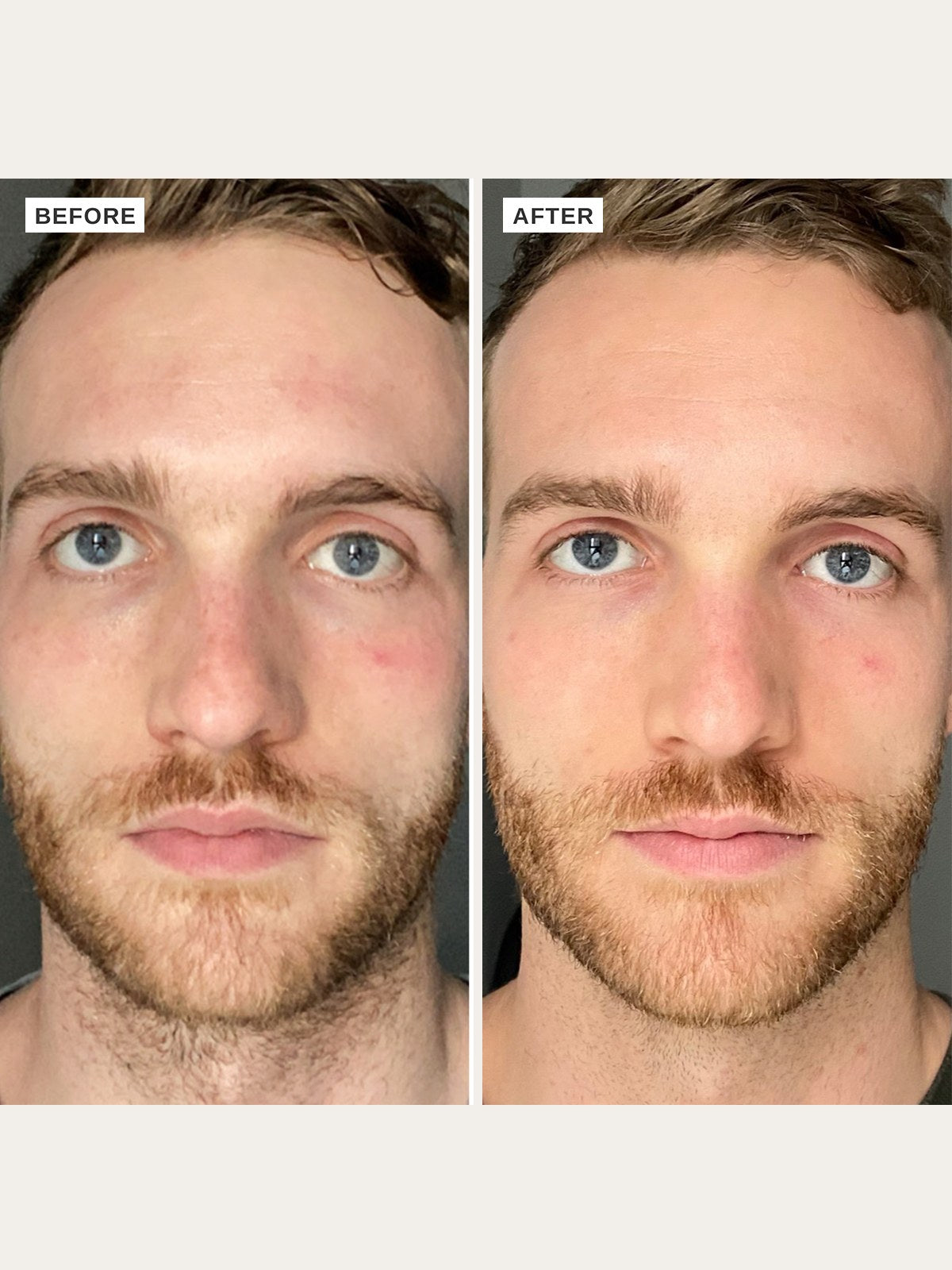 Alpha-H Vitamin B Serum antes y después resultado dos
