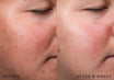 Medik8 r-Retinoate Intense - Night cream resultaat