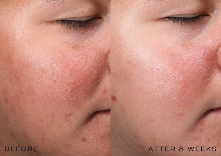 Medik8 r-Retinoate Intense - Night cream resultaat