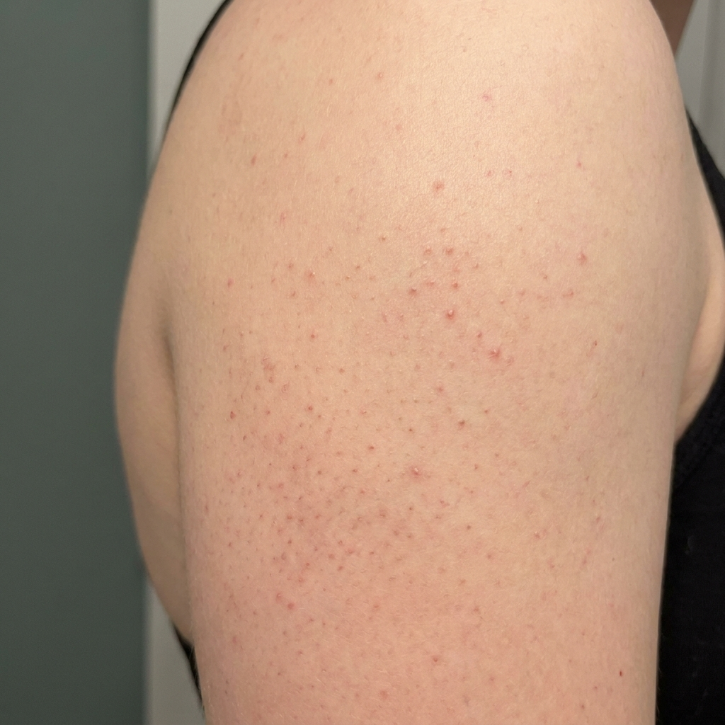 Keratosis pilaris: kippenvelbultjes gladder maken